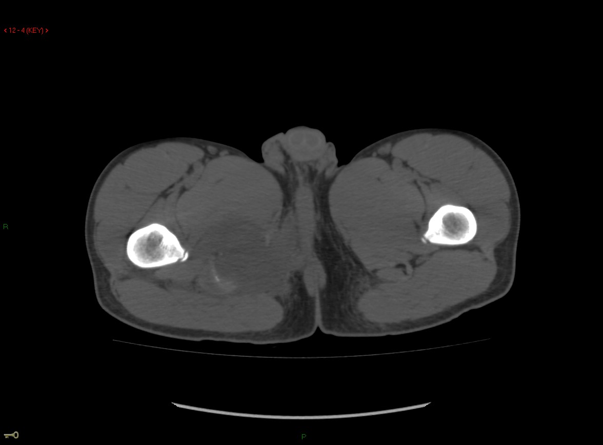 Figure 2 for case Ischial tuberosity ( RID2550 ) avulsion